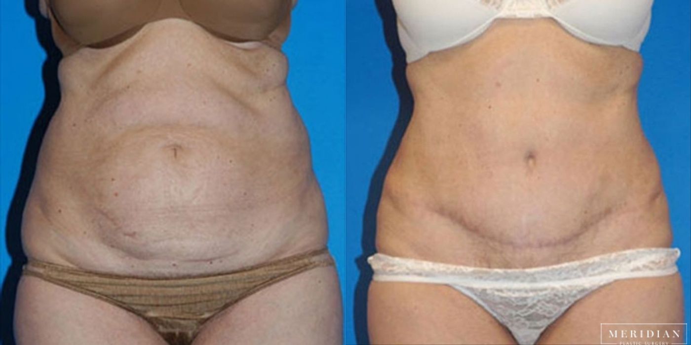 Body Contouring - Case 8448