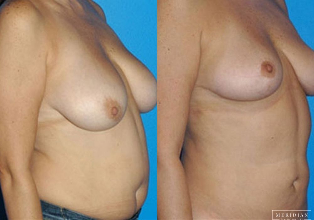 Body Contouring - Thumbnail 2