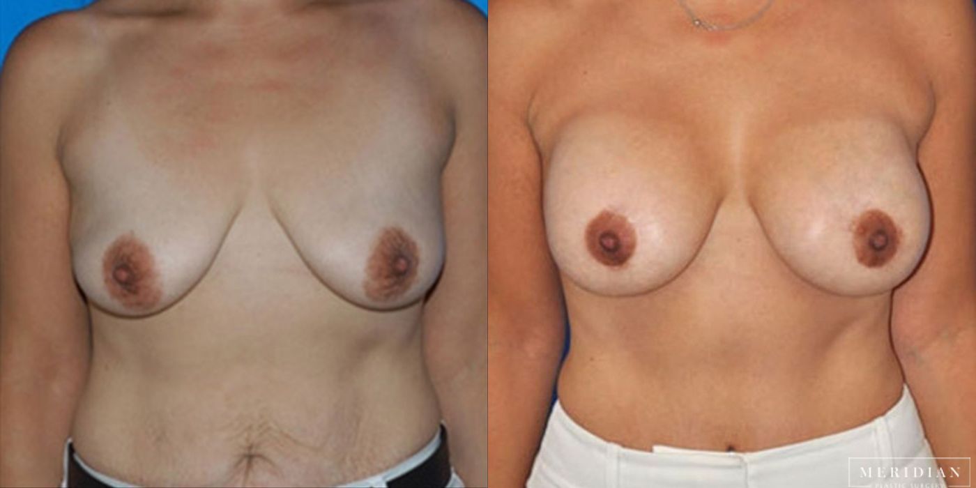 Body Contouring - Case 8467