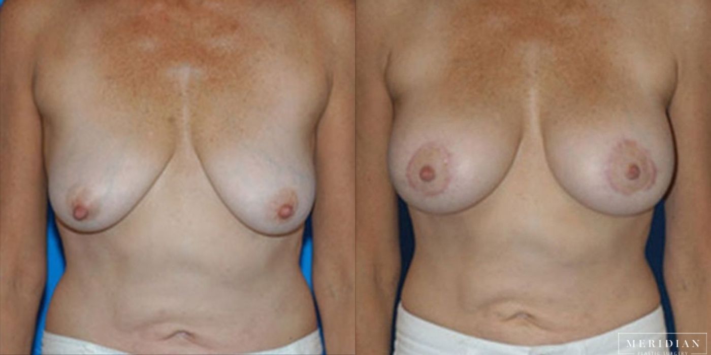 Body Contouring - Thumbnail 2