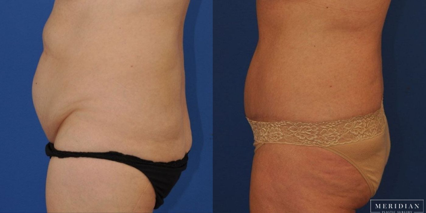 Body Contouring - Thumbnail 3