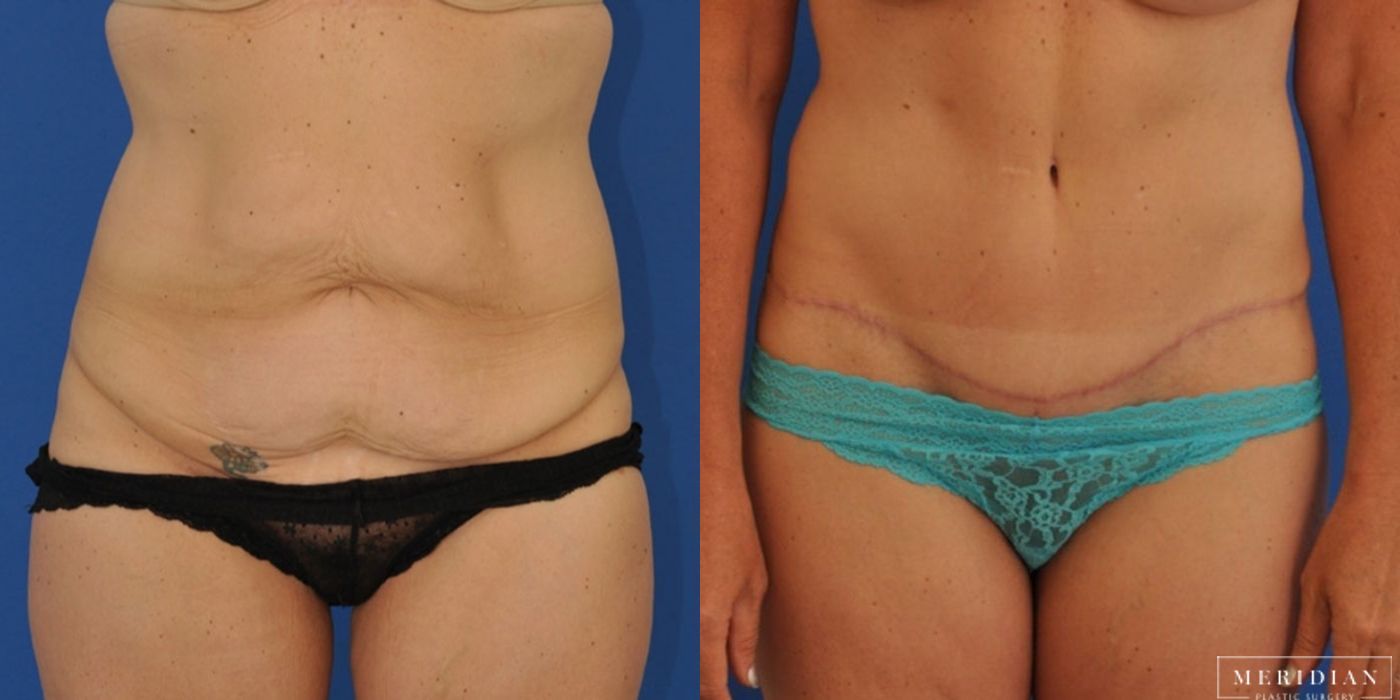 Body Contouring - Case 8454