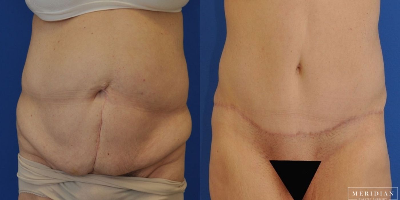 Body Contouring - Thumbnail 2