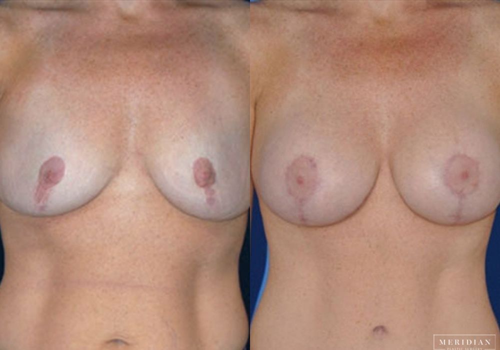 Body Contouring - Case 7983