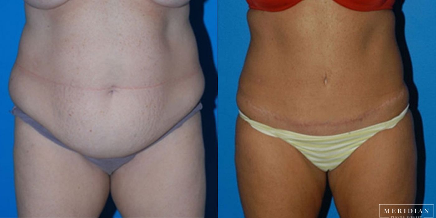 Body Contouring - Case 8447