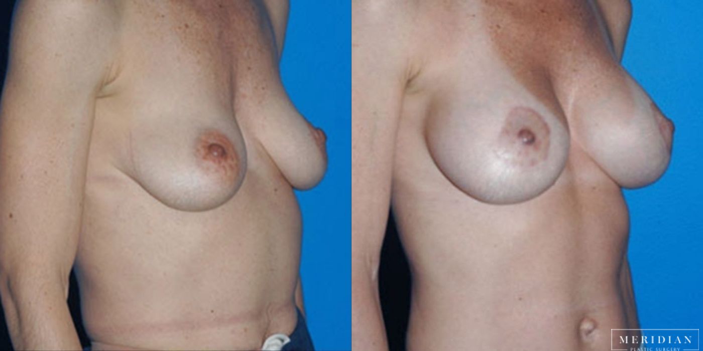 Body Contouring - Thumbnail 2