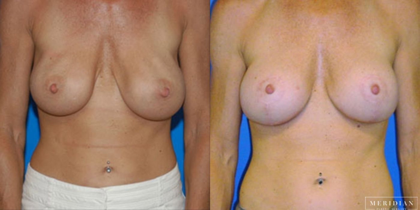 Body Contouring - Case 8465