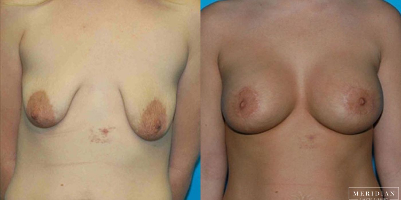 Body Contouring - Case 8469