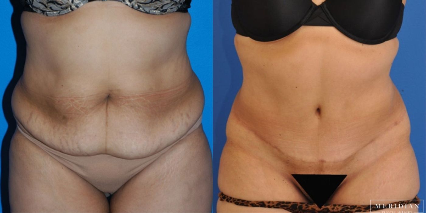 Body Contouring - Case 8452