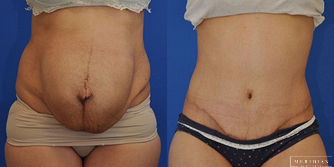 Body Contouring - Thumbnail 2