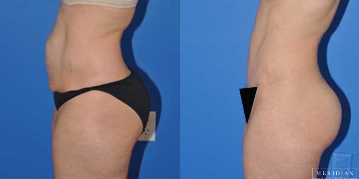 Body Contouring - Thumbnail 2