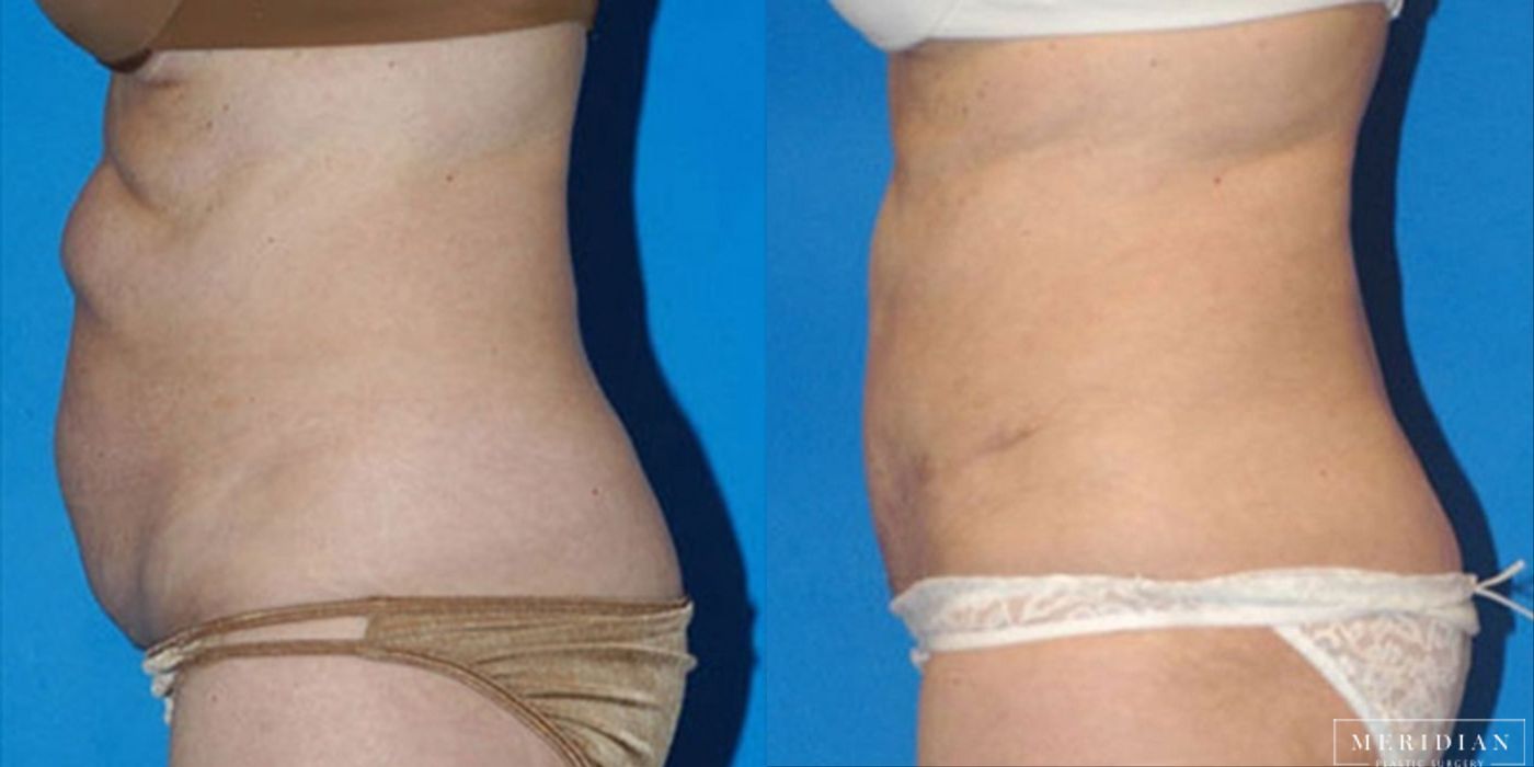 Body Contouring - Thumbnail 2