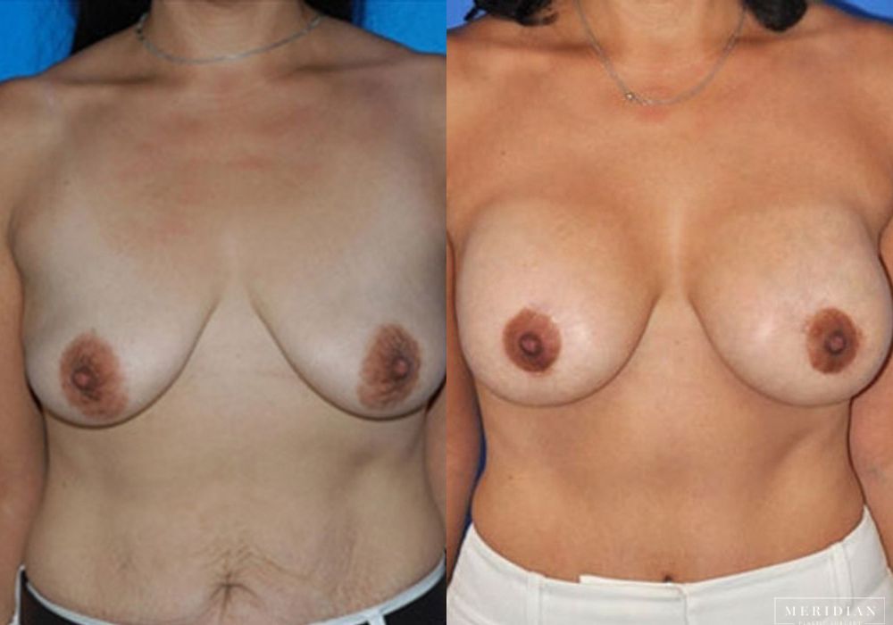 Body Contouring - Case 7984