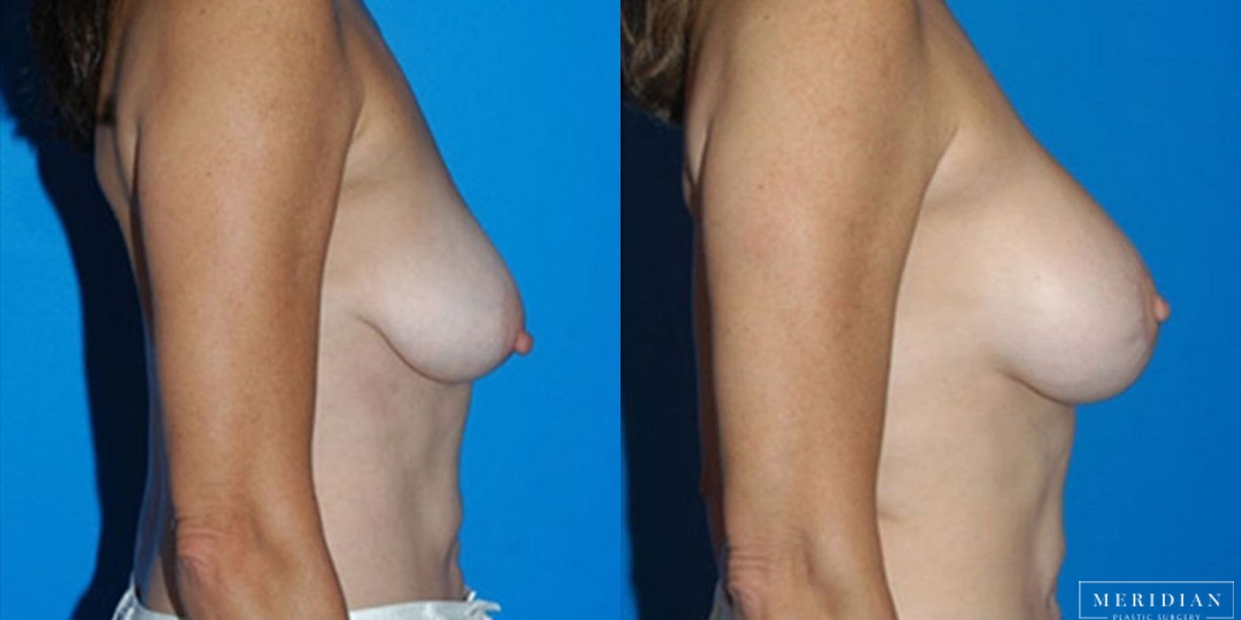 Body Contouring - Case 8468