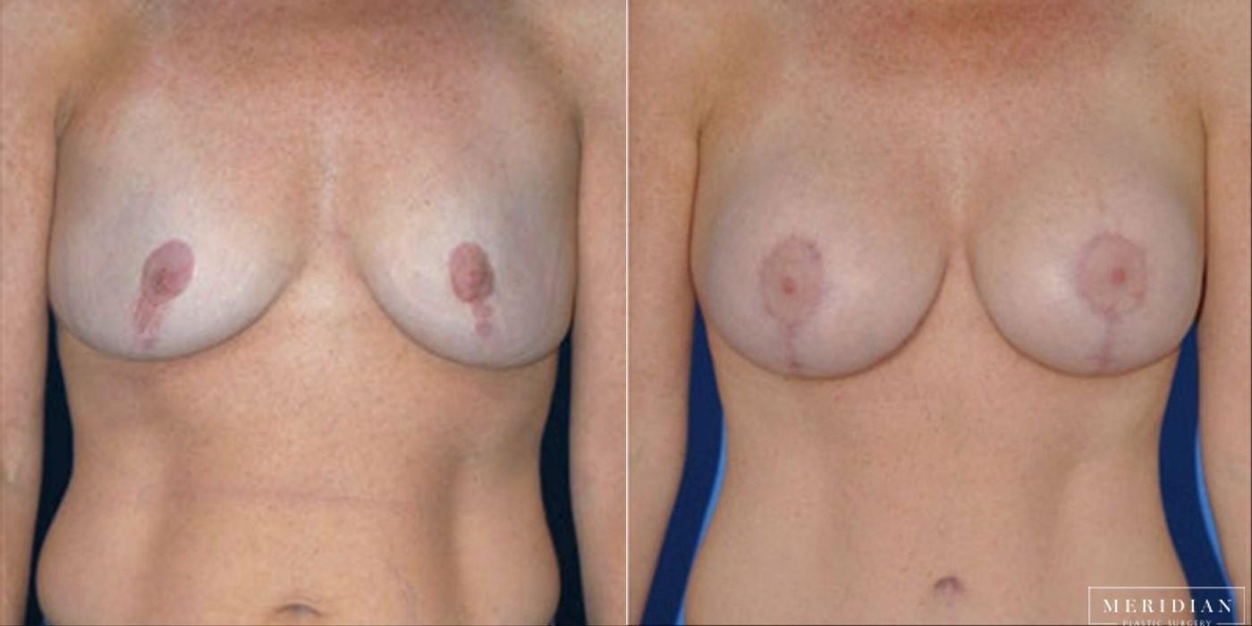 Body Contouring - Case 8466