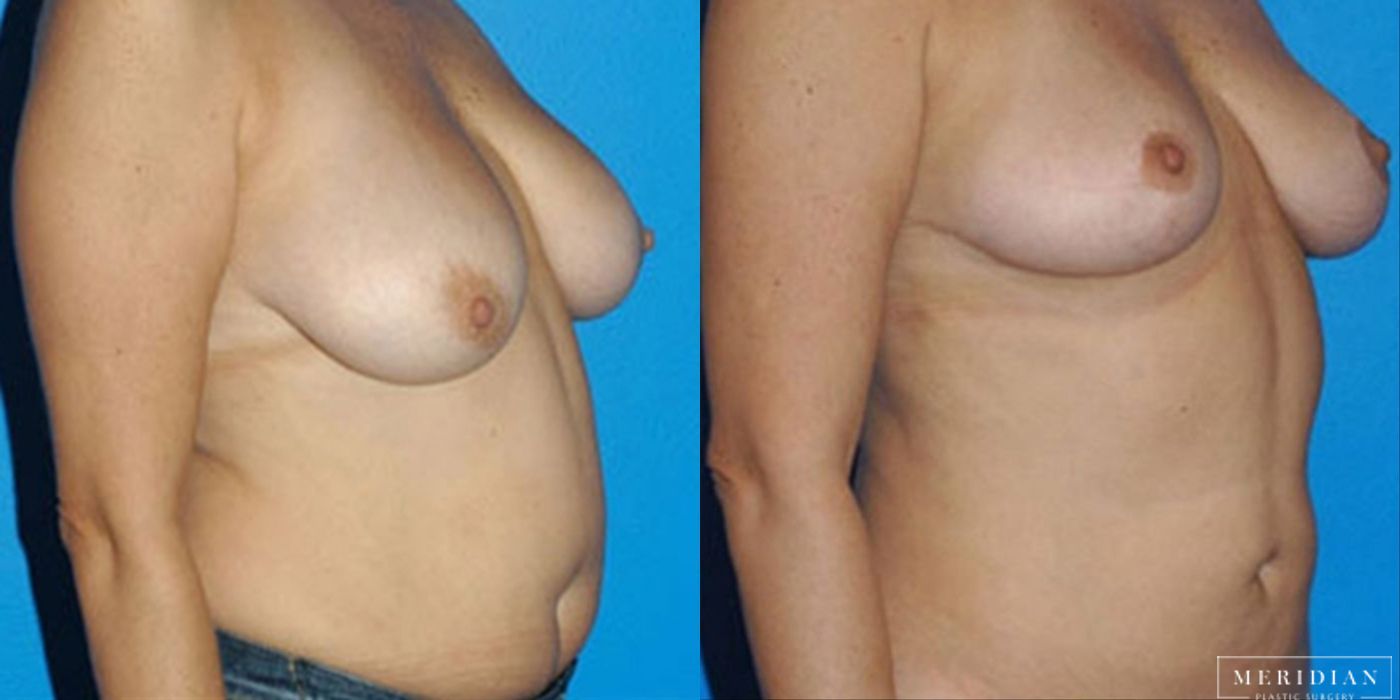 Body Contouring - Thumbnail 2