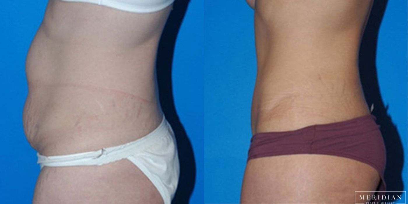 Body Contouring - Thumbnail 2