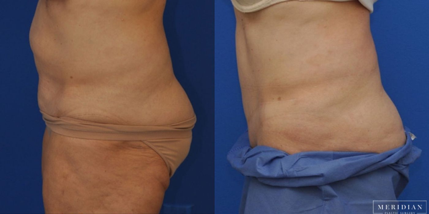 Body Contouring - Thumbnail 2