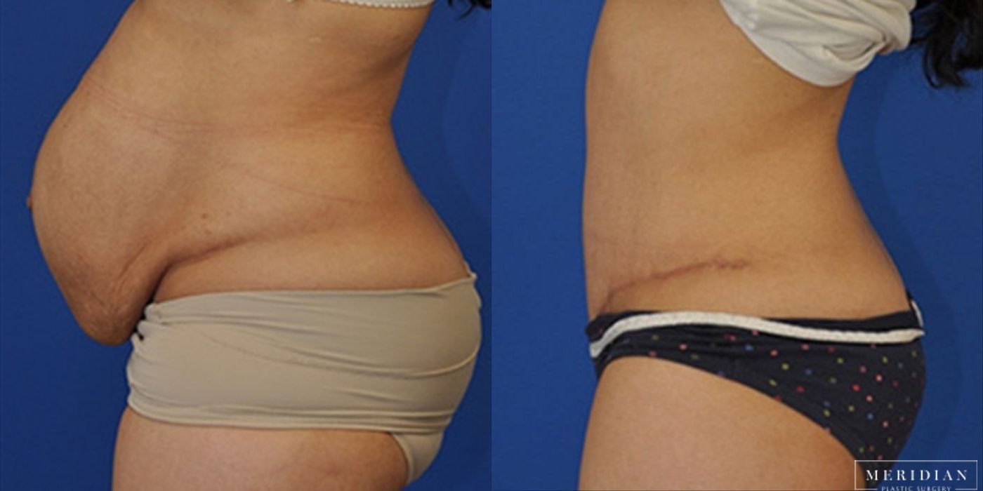 Body Contouring - Case 8445