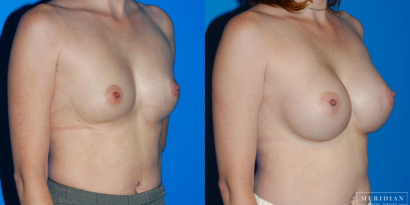 Breast Augmentation - Thumbnail 2