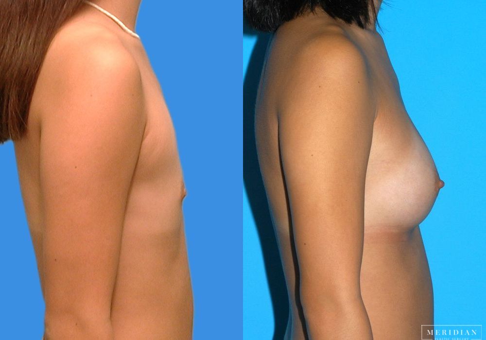 Breast Augmentation - Thumbnail 3