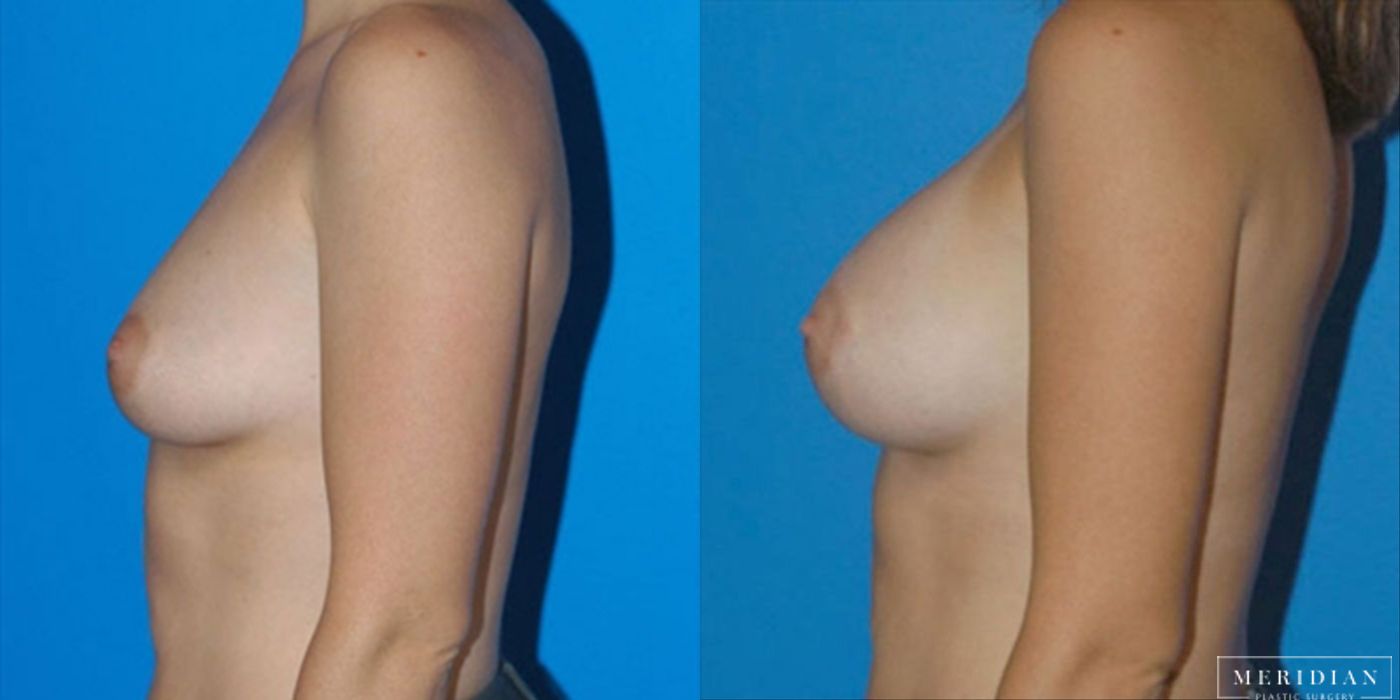 Breast Augmentation - Thumbnail 2