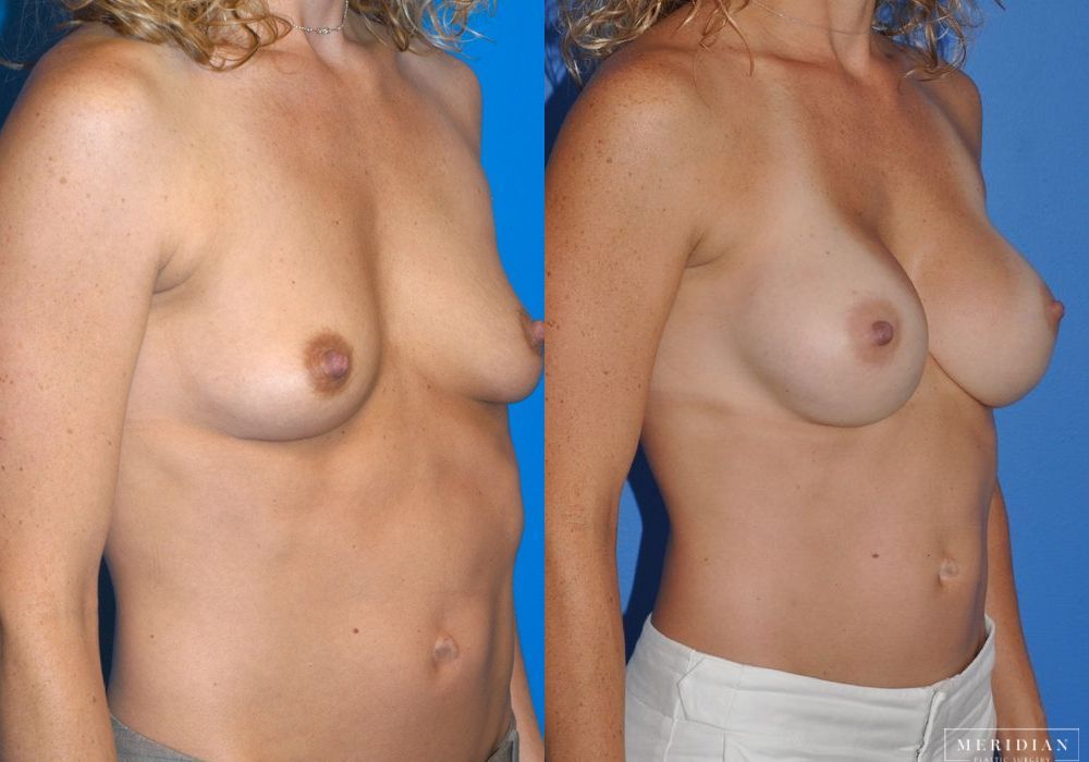 Breast Augmentation - Thumbnail 2