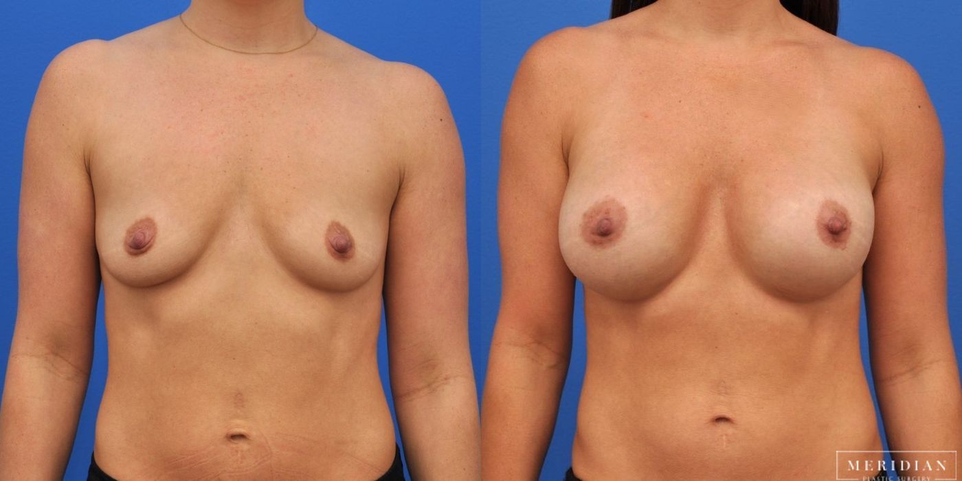 Breast Augmentation - Case 8050