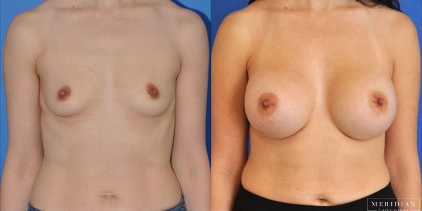 Breast Augmentation - Thumbnail 2