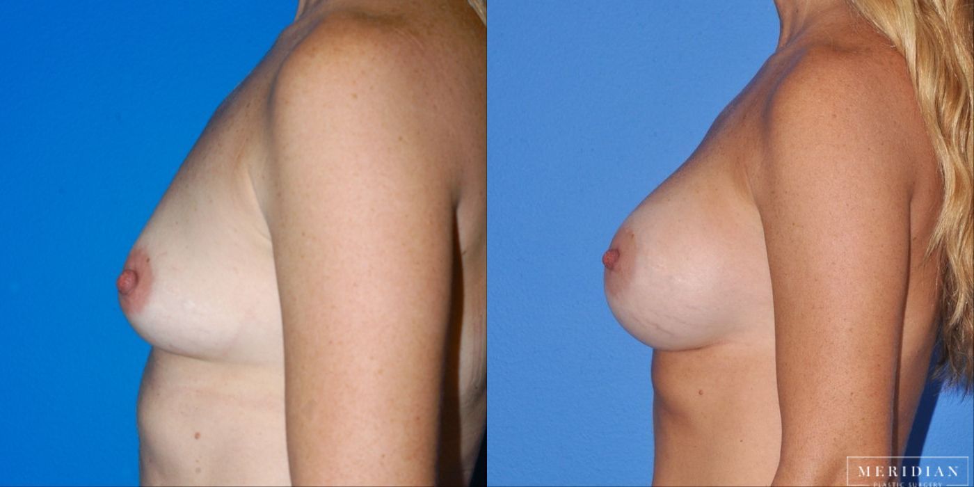 Breast Augmentation - Thumbnail 3