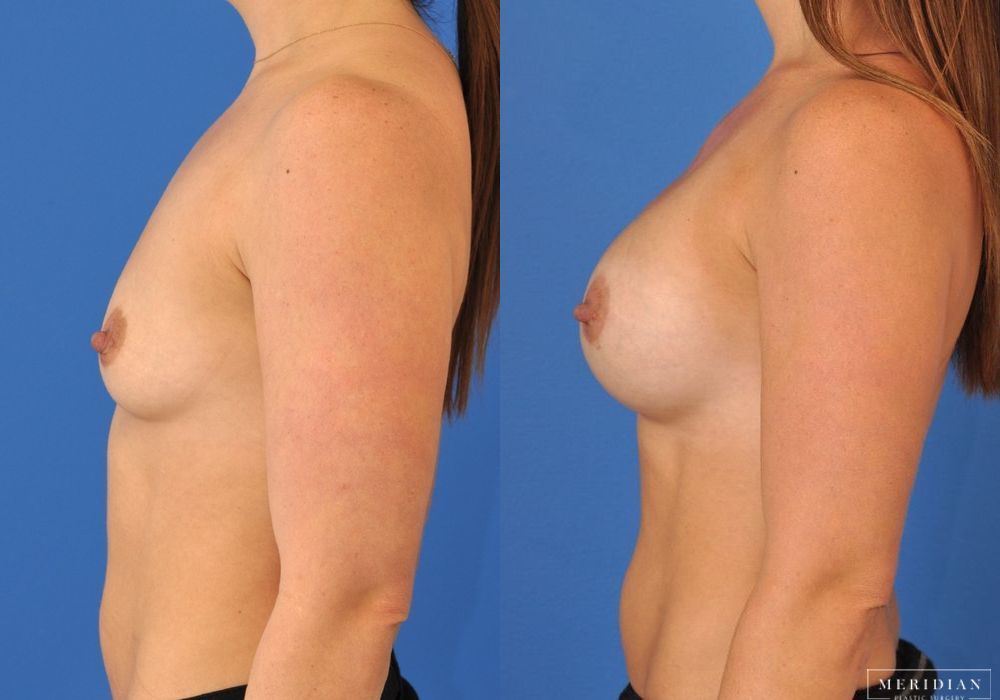 Breast Augmentation - Thumbnail 3