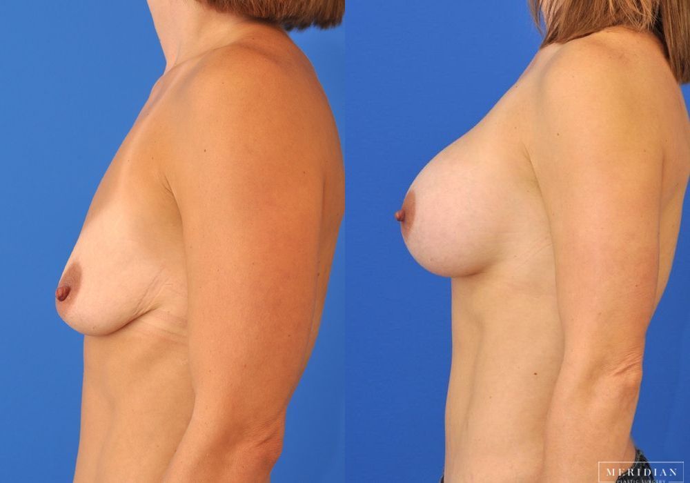 Breast Augmentation - Thumbnail 3