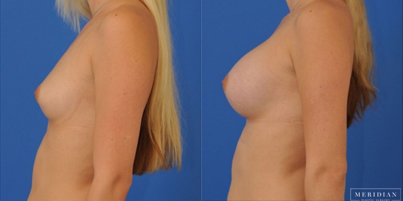 Breast Augmentation - Case 8524