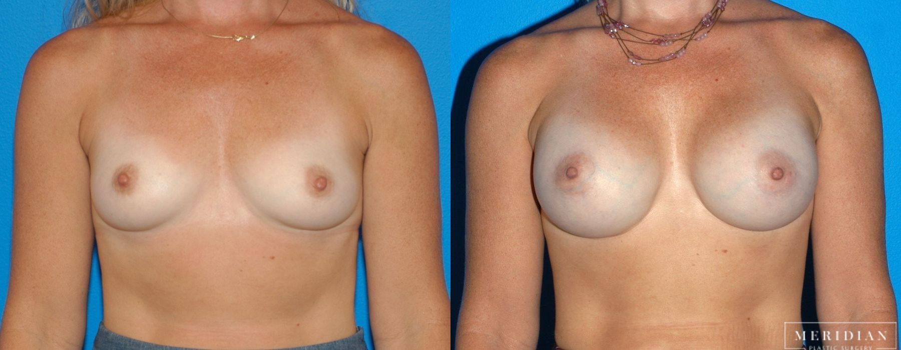 Before and after procedure result