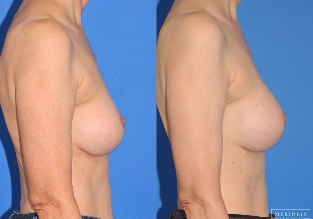 Breast Augmentation - Thumbnail 3