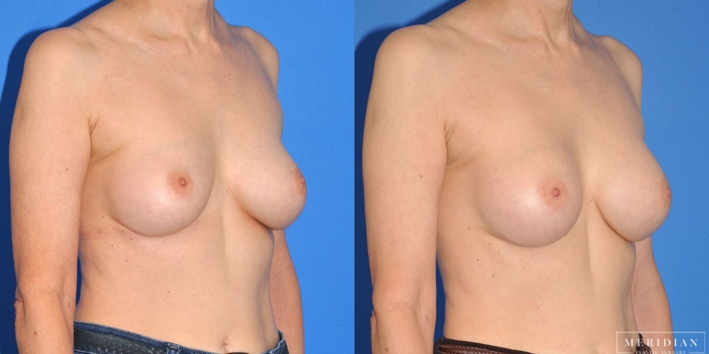 Breast Augmentation - Thumbnail 2