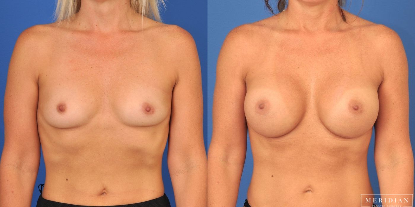 Breast Augmentation - Case 8033
