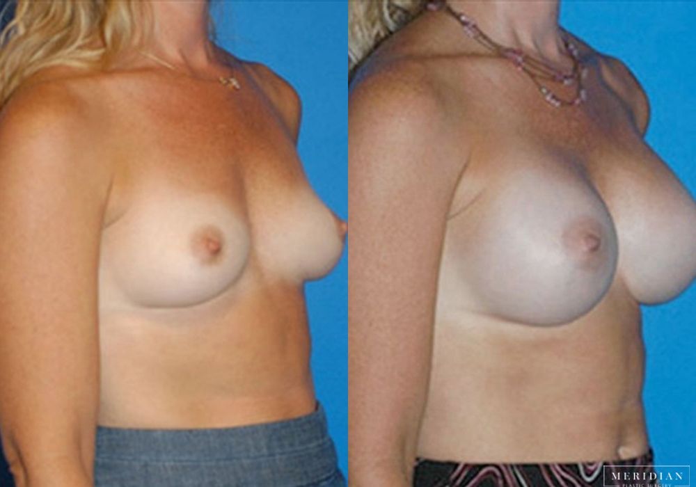 Breast Augmentation - Thumbnail 2