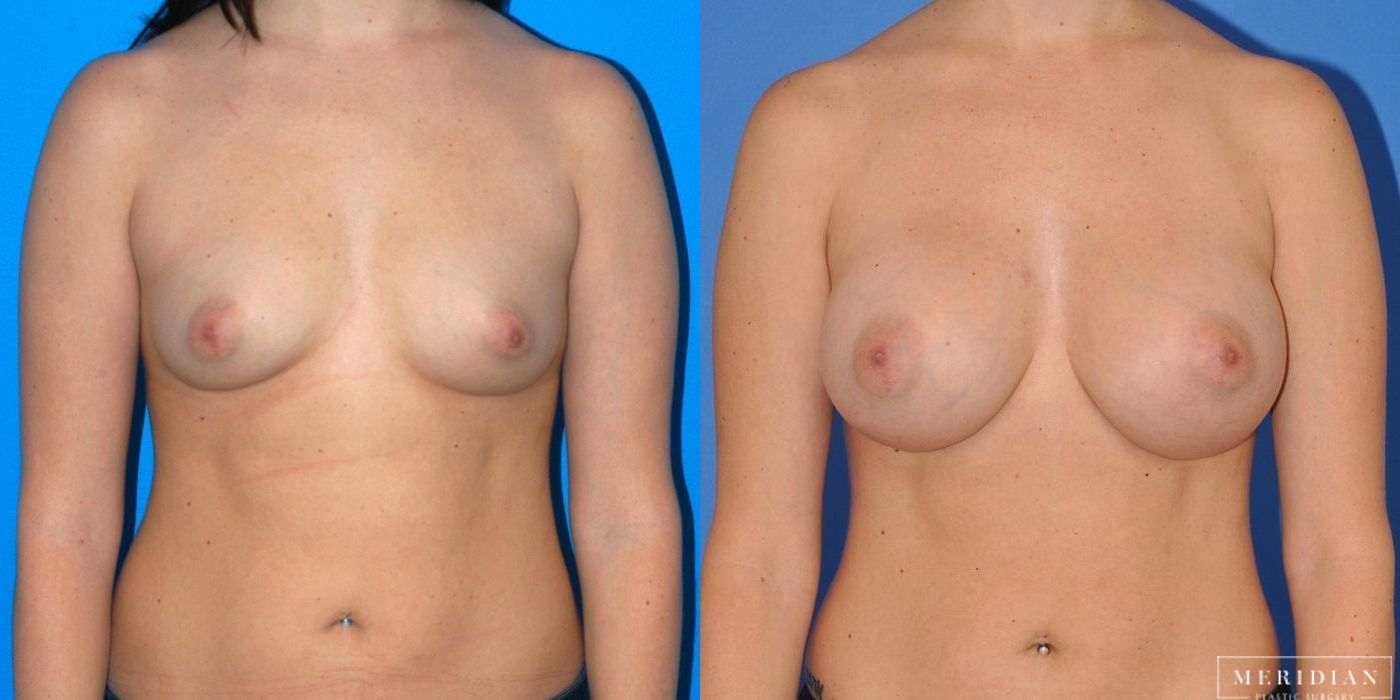 Breast Augmentation - Case 8056
