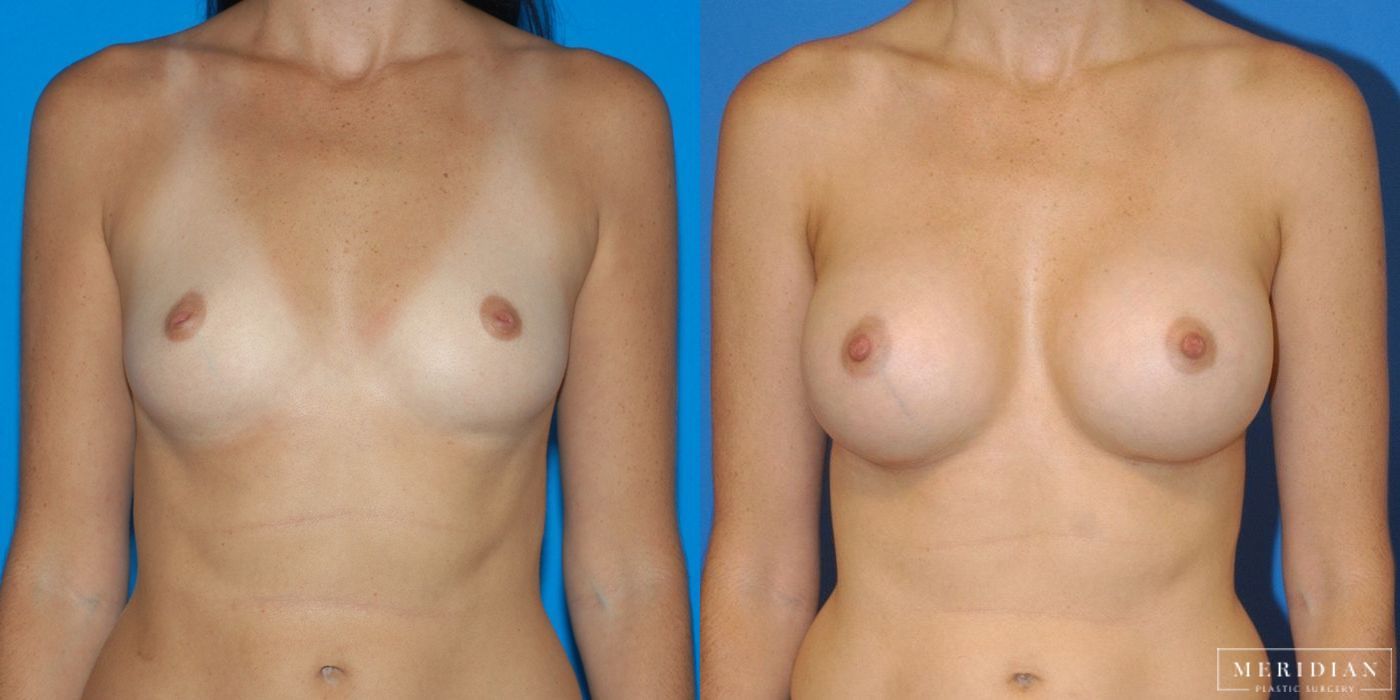 Breast Augmentation - Case 8723