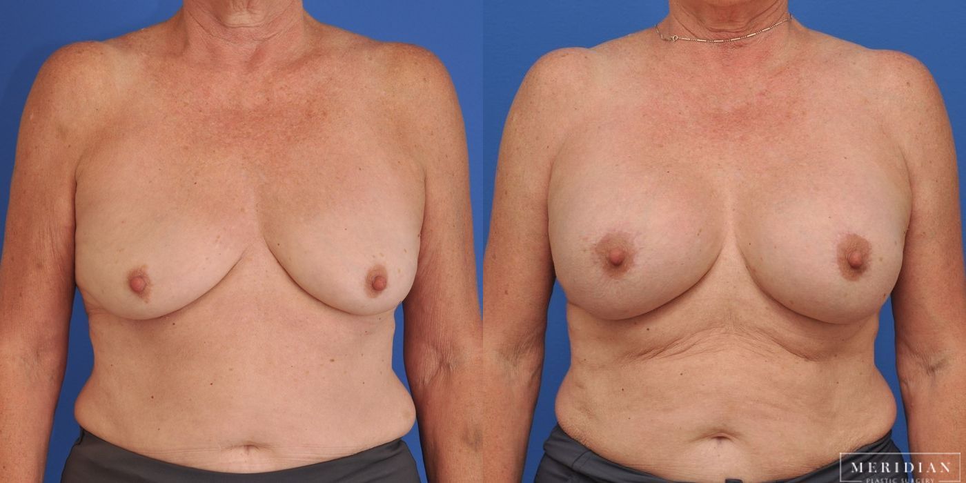 Breast Augmentation - Case 8024