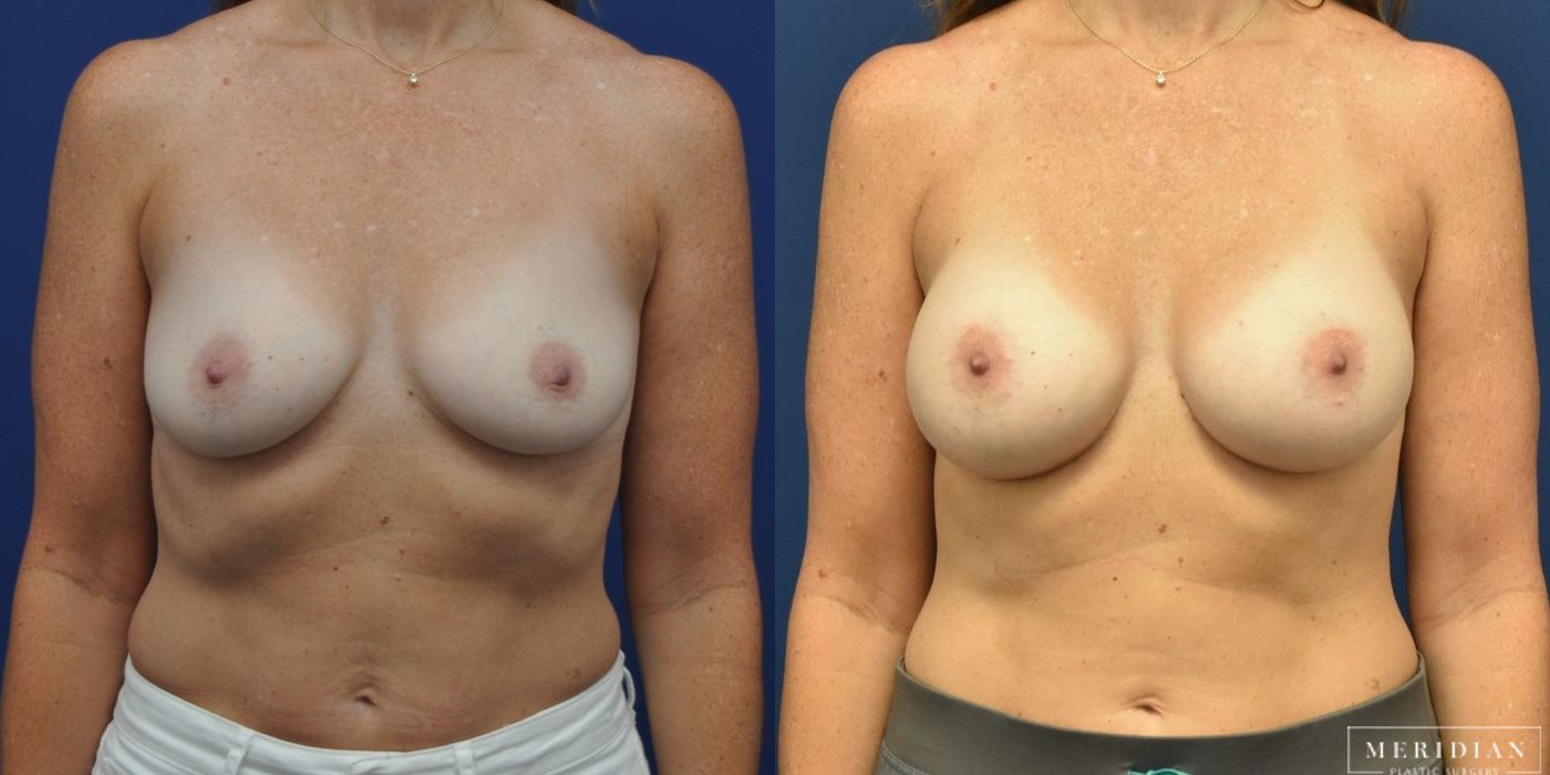 Breast Augmentation - Thumbnail 2