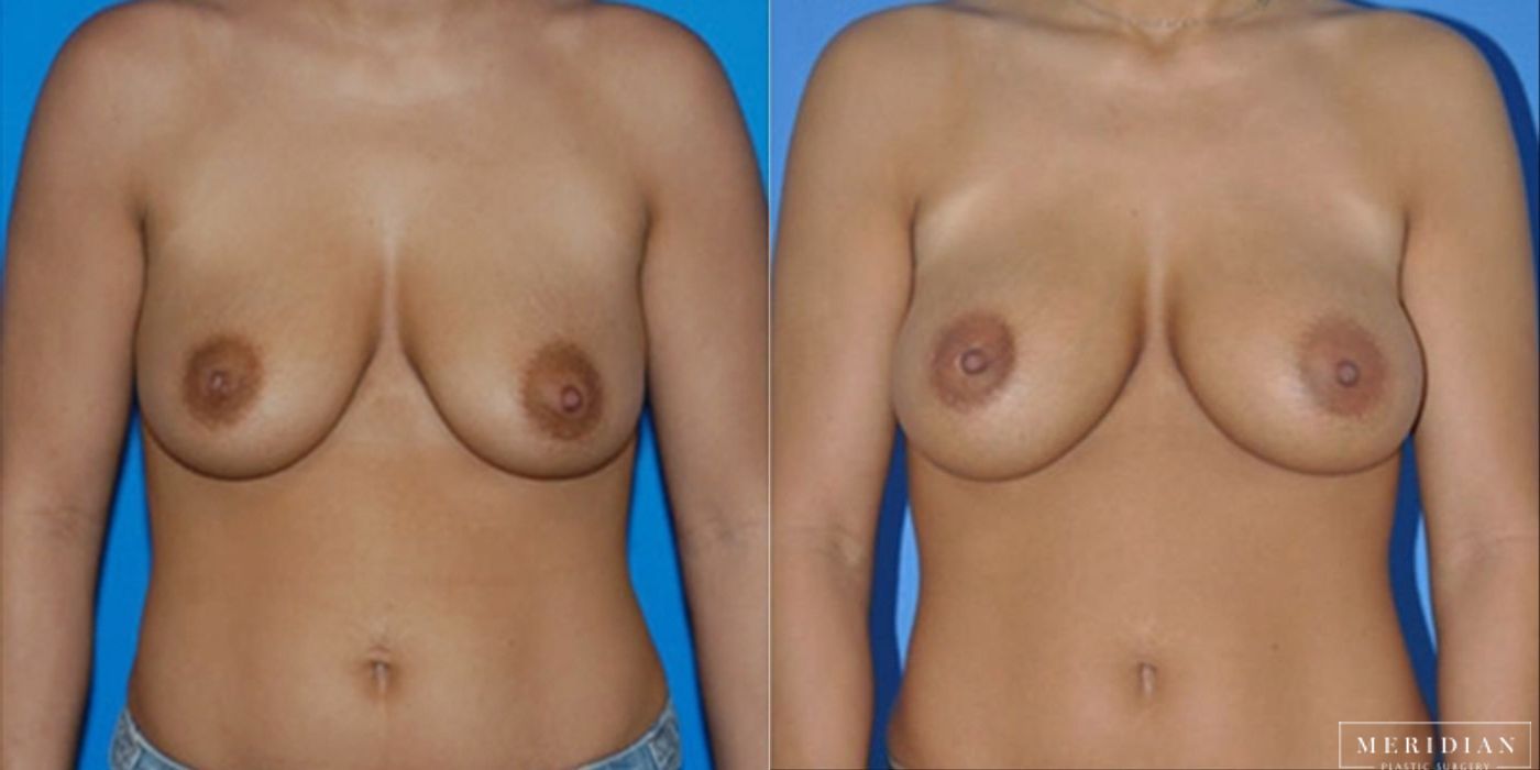 Breast Augmentation - Case 8518