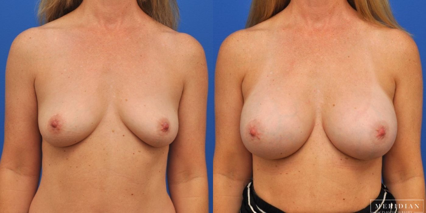 Breast Augmentation - Case 8020