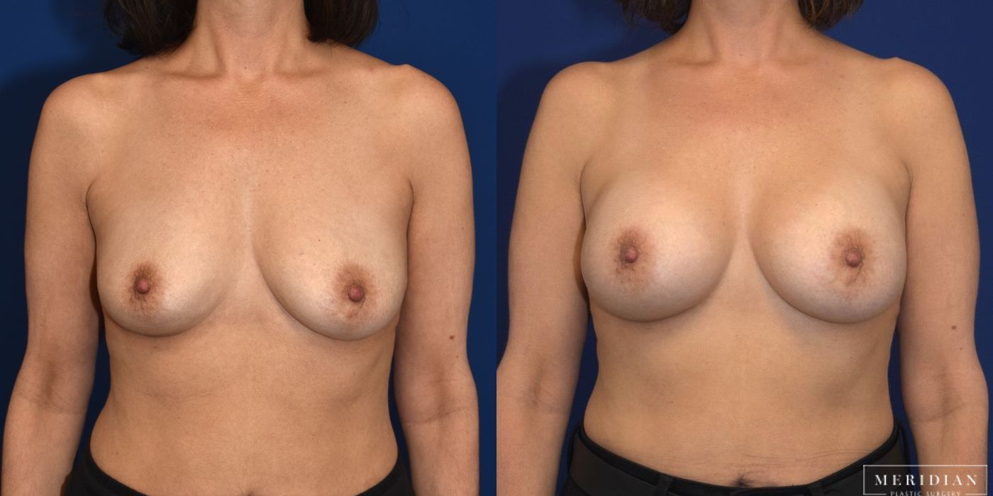 Breast Augmentation - Case 8029