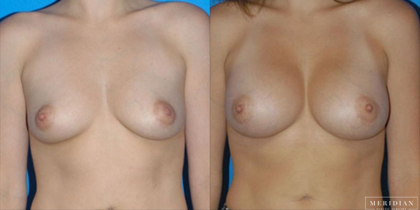 Breast Augmentation - Case 8523