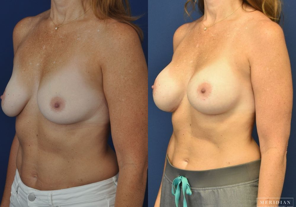 Breast Augmentation - Thumbnail 2