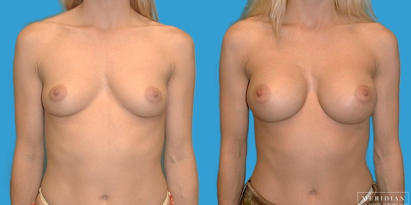Breast Augmentation - Case 8048