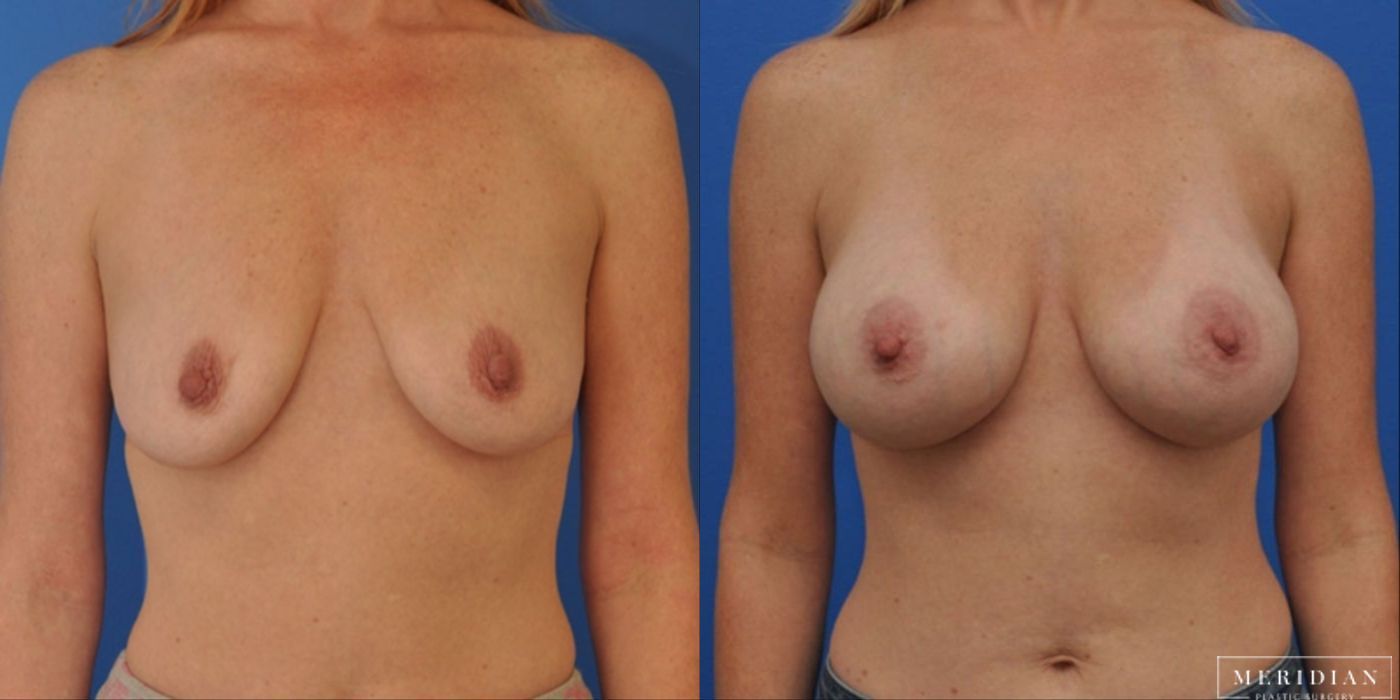 Breast Augmentation - Thumbnail 2