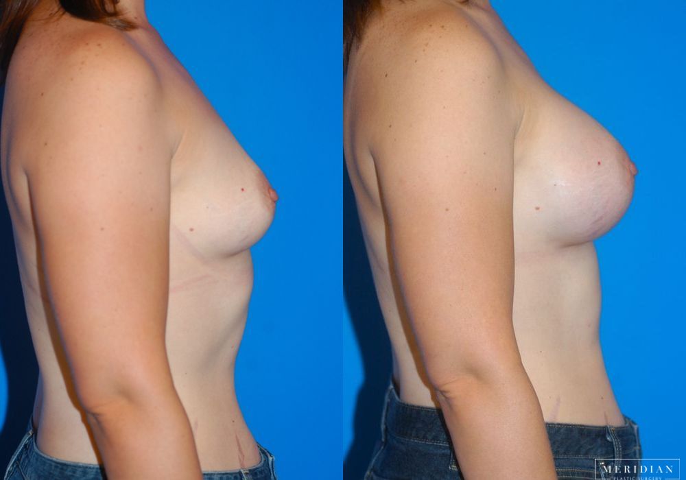 Breast Augmentation - Thumbnail 3